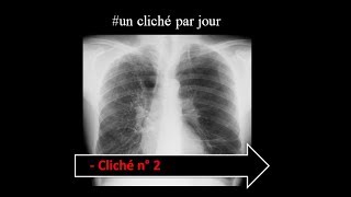 unclichéthoraciqueparjour  interprétation radiologique type emphysème pulmonaire diffus [upl. by Fraser]