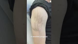 Laser tattoo removal results lasertattooremoval beforeandafter skincare tattoos satisfying [upl. by Bruns]