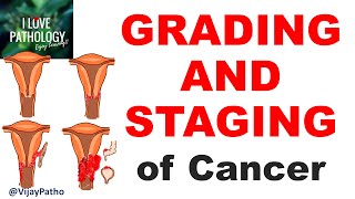 NEOPLASIA Part 11 GRADING and STAGING of cancer [upl. by Ferdinanda102]