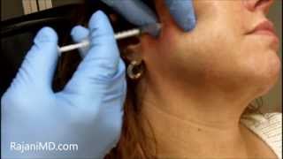 Watch Botox Facial Shaping and TMJRajani [upl. by Anawak120]