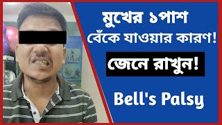 বেলস পালসি কি  মুখ বাঁকা হওয়ার কারণ কী মুখ বাঁকা বা বেলস পালসি  বেলস পালসি  bells palsy Bangla [upl. by Dionysus]