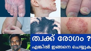 Psoriasis  Skin diseases treatment  Mohanan Vaidyar [upl. by Sidney634]