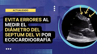 ⛔️EVITA ERRORES al medir el ✅DIÁMETRO DEL SEPTUM INTERVENTRICULAR por ecocardiografía [upl. by Maller]