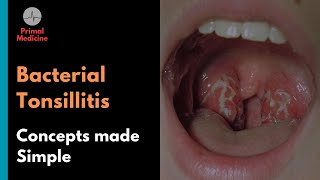 Bacterial Tonsillitis Centor Criteria and FeverPAIN Score [upl. by Malorie638]