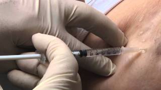 HYPERHIDROSIS BOTOX INJECTIONS with Dr Joel Spitz [upl. by Mirth]