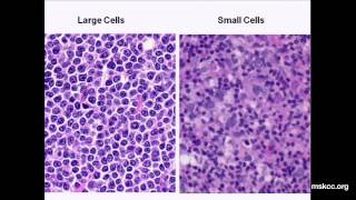 What You Need to Know about NonHodgkins Lymphoma Presentation [upl. by Ever]