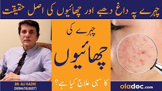 Chehre Ki Chaiyan Khatam Karne Ka Tarika  Pigmentation Melasma Treatment  Dagh Dhabo Ka Sahi Ilaj [upl. by Lednahs]