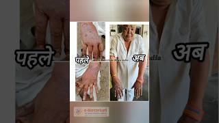 Skin Disease  16 साल से त्वचा रोग पर सुकुन परिणाम मिला  Psoriasis Result EBIOTORIUM100 [upl. by Tnerb178]