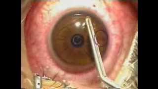 Lasik Laser Eye Surgery Procedure  Live Surgery [upl. by Sillert]