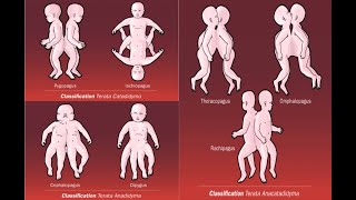 Types of conjoined conjoint twins  Omphalopagus Pygopagus Craniopagus Diprosopus Parapagus [upl. by Menzies]