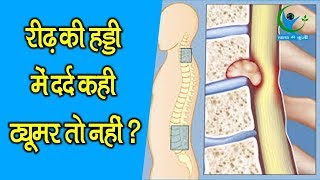 रीढ़ की हड्डी में दर्द रहना ट्यूमर का है संकेत SPINAL CORD PAIN IS THE SIGN OF TUMOR [upl. by Daile301]