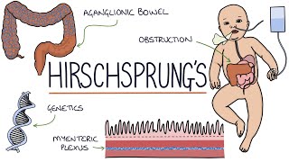 Hirschsprungs Disease [upl. by Loise]