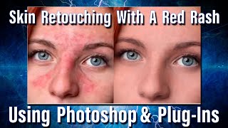 Retouching skin with a bad rash in Adobe Photoshop [upl. by Denney]