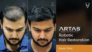 Artas Robotic Hair Restoration  Musk Clinic [upl. by Ameluz43]