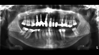 für Zahnärzte das OPTG Röntgen [upl. by Omissam]
