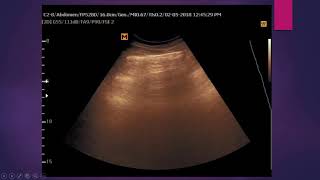 Focal Fat sparing of the liver parenchyma [upl. by Aroved]