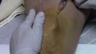 Prolozone Injections [upl. by Uird]