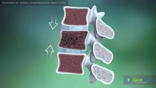 Spinal Compression Fracture Reasons [upl. by Madriene]