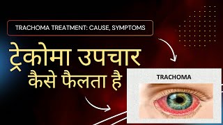 quotTrachoma Treatment Cause Symptoms  IN HINDI ट्रेकोमा उपचारकैसे फैलता है” [upl. by Sylvanus]