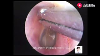 Treatment of foreign bodies cerumen and fungi on tympanic membrane surface for 11 minutes [upl. by Rob]