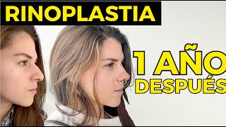 RINOPLASTIA 1 AÑO DESPUÉS RESULTADOS  Melanie Brecht [upl. by Felike]