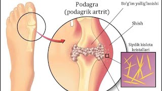 Podagra kasalligi haqida Подагра касаллиги [upl. by Asteria]