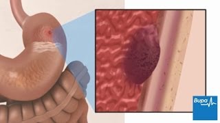 How a peptic ulcer develops  Bupa Health [upl. by Mike420]