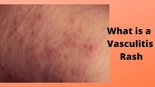 What is a Vasculitis Rash [upl. by Gusella]