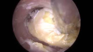 FUNGAL Ear Wax Removal Otomycosis in Otitis Externa Ear Canal  323 [upl. by Medardas6]