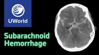 Subarachnoid Hemorrhage amp Treatment  nimodipine USMLE STEP 1 UWORLD Questions Nervous system [upl. by Gnilhsa384]