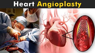 How Angioplasty Procedure Is Performed  Balloon Angioplasty And Coronary artery stent UrduHindi [upl. by Olmstead]