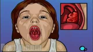 Tonsillectomy Surgery PreOp® Patient Education HD [upl. by Detta]