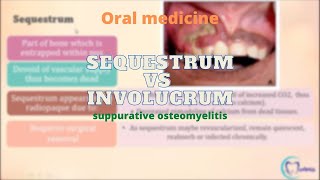 Sequestrum Vs Involucrum  Osteomyelitis  Oral Medicine  Dentophile [upl. by Nnaeitak923]