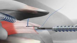 Rotator Cuff Repair with Arthrex® SutureBridge™ [upl. by Annayk]