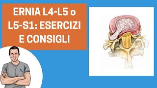 Ernia L4L5 o L5S1 ecco come curarsi consigli ed esercizi [upl. by Arataj533]