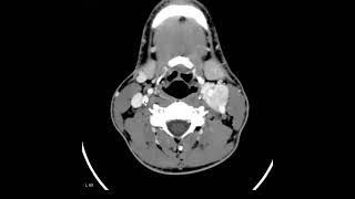 Paraganglioma do corpo carotídeo [upl. by Schroth775]