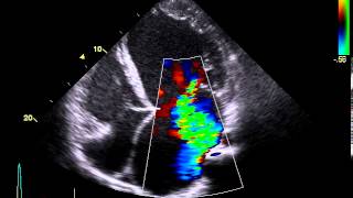 Insuficiencia mitral severa [upl. by Luaped]