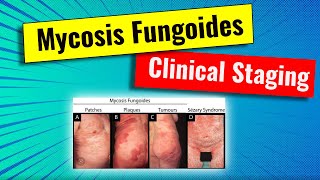 Staging of Mycosis fungoides MF  video series for dermatology residency and USMLE [upl. by Venditti]