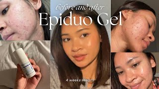 BEFORE and AFTER using Epiduo Gel how I use it to get rid of my acne  NinaSThuay [upl. by Pruter]