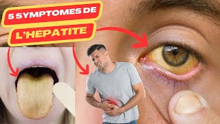 5 symptômes de lhépatite  hépatite virale c  hépatite virale b  hepatite a  hépatite [upl. by Edmund]