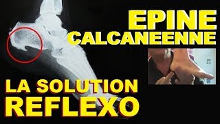 EPINE DU TALON CALCANEENNE DE LENOIR ESSAYEZ LA REFLEXOLOGIE PLANTAIRE LA SOLUTION NATURELLE [upl. by Eillit]