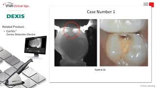 Pinpointing Interproximal Decay amp Incipient Caries—with Dr Lester Appell [upl. by Lindgren]