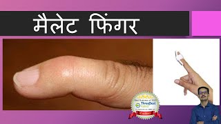 Mallet Finger Hindi [upl. by Occer]