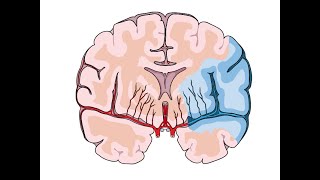 USMLE Step 2 CK Plus  Chapter 2 Neurology  Stroke [upl. by Gintz]