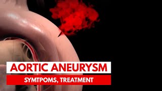 What is an Aortic Aneurysm  3D Animation [upl. by Hcelemile]