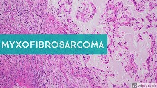 Myxofibrosarcoma 101Explained by a Sarcoma Pathologist [upl. by Gagliano]