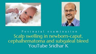 Scalp swelling in newborn period caput cephalhematoma subgaleal bleed Dr Sridhar K [upl. by Pyle873]