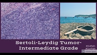 Sertoli Leydig Tumor Moderately Differentiated [upl. by Ecurb]