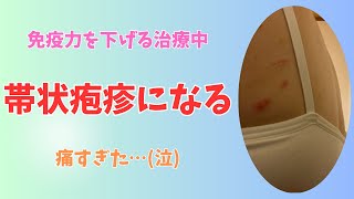 【帯状疱疹】点滴の副作用で痒くなったと思ったら帯状疱疹でした… [upl. by Oirotciv]