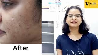 Real Results Pigmentation amp Adult Acne Treatment at Vida Clinic [upl. by Hniv]